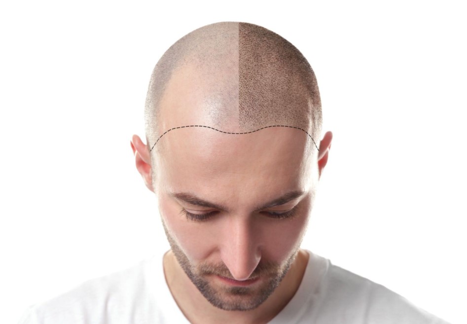 Can Hair Loss Be Treated With Scalp Micropigmentation?